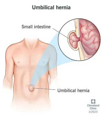 Umbilical Hernia service image