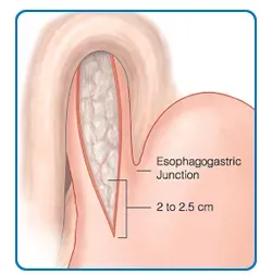 Laparoscopic Heller Procedure (Cardiomyotomy) service image