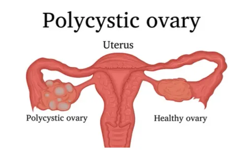 PCOS Treatment in Pune service image