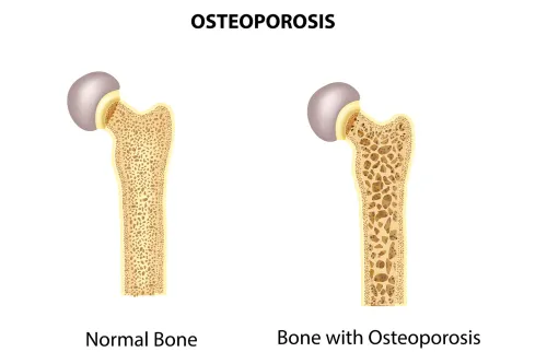 Osteoporosis Treatment in Pune service image