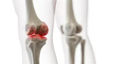 Bone Disorders Treatment in Pune service image