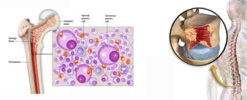 Myeloma Cancers product image