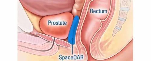 Prostate Cancers product image
