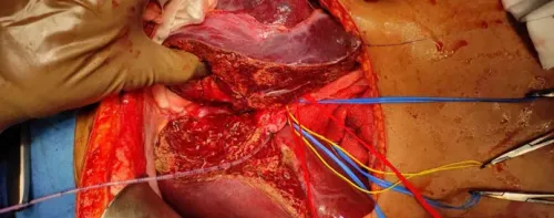 HPB Surgery service image