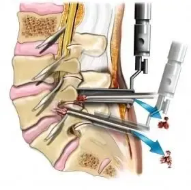 Microlumbar Discectomy service image