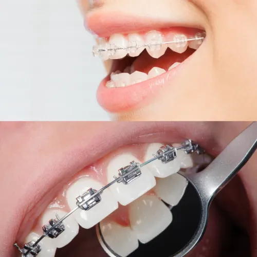 Braces service image
