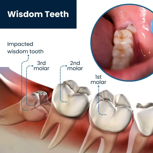 Wisdom Teeth Removal service image