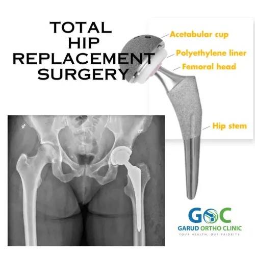 Total Hip Replacement service image