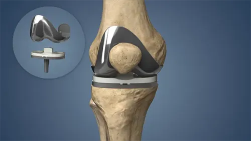 Total Knee Replacement service image