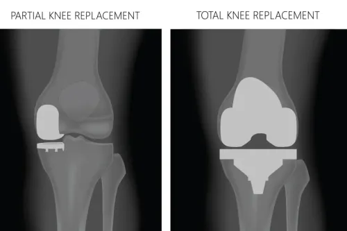 Partial Knee replacement Surgery service image