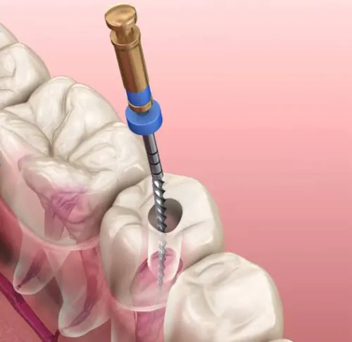  Endodontogy  Treatments service image