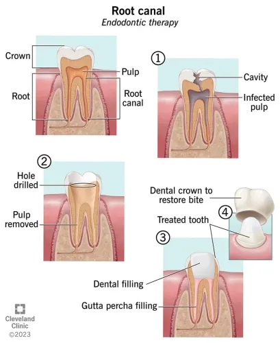 ROOT CANAL TREATMENT service image