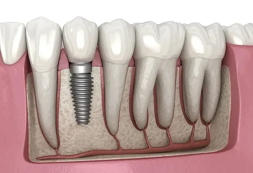 IMPLANTS service image