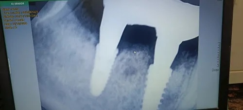 Dental Implants service image