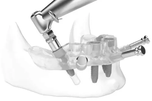 Digital Guided Implant Dentistry service image