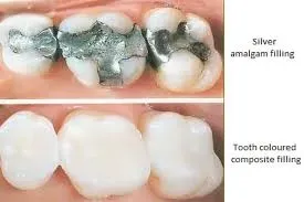 Dental Filling service image