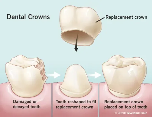CAP PLACEMENT product image