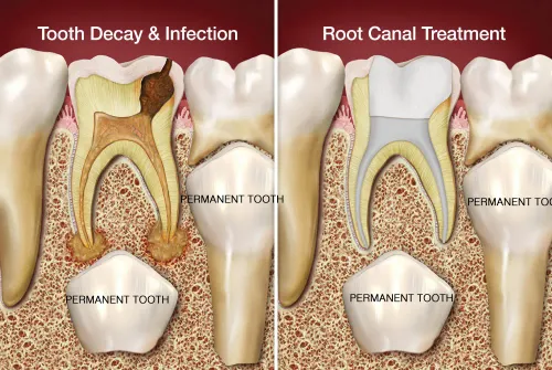 KIDS FILLINGS AND ROOT CANAL TREATMENT AND CAP PLACEMENT product image