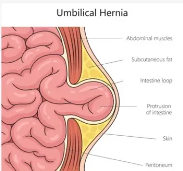 Robotic Umbilical hernia repair service image