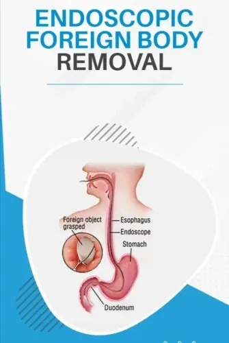 Endoscopic Foreign Body Removal service image