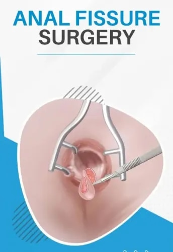 Anal Fissure Surgery service image