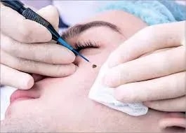 ADVANCED ELECTROLYSIS FOR MILIA AND WARTS service image