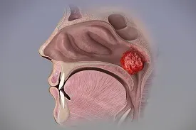 Adenoids Treatment service image