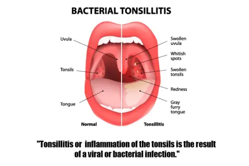 Tonsillitis service image
