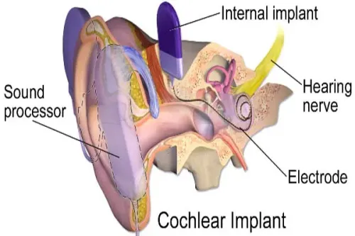 Cochlear Implant service image