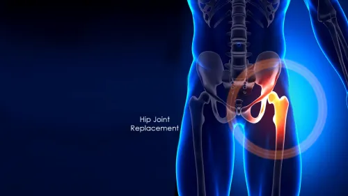 Hip Replacement service image