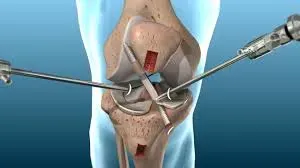Ligament Reconstruction  service image