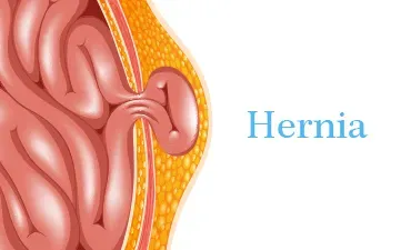 Hernia Surgeon in Viman Nagar, Kharadi, Vishrantwadi, Pune service image