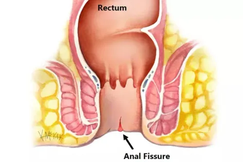Anal Fissure Treatment Doctor in Viman Nagar, Kharadi, Vishrantwadi, Pune service image
