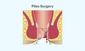 Laser Piles Surgeon in Viman Nagar, Kharadi, Vishrantwadi, Pune service image