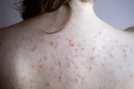 Back acne treatment service image