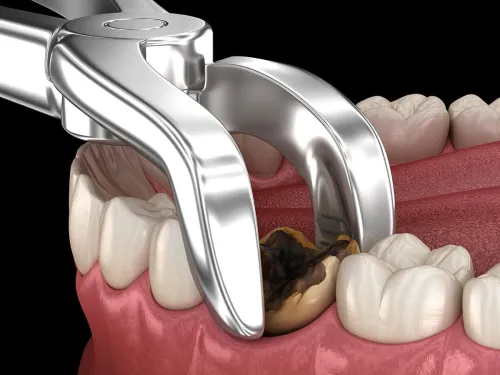 Tooth Extraction (Including Third Molars) service image