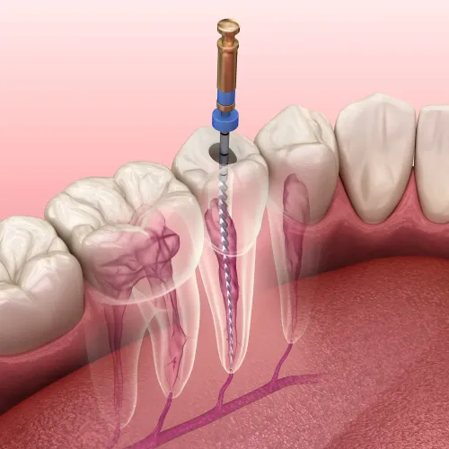 Root Canal Treatment service image