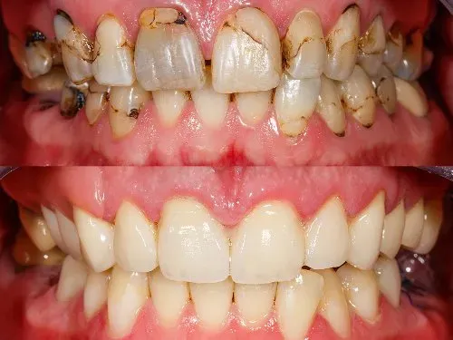 Full Mouth Rehabilitation service image