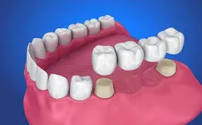 Fixed Teeth (Crowns & Bridges) service image