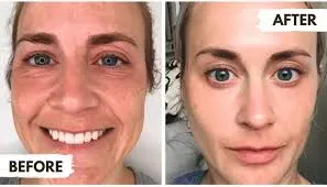 Plasma Pen Anti-Aging Treatment service image