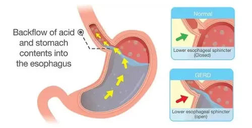 Gastroesophageal Reflux Disease (GERD) service image