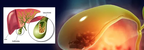 Gallstones service image