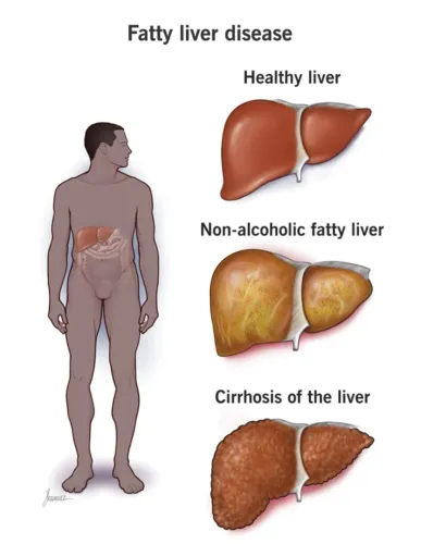 Fatty Liver Treatment Specialist in Pune, PCMC, Maharashtra  service image