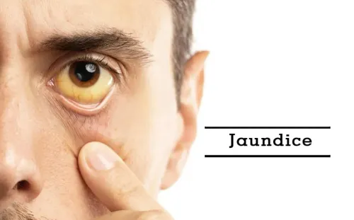 Jaundice Treatment Specialist in Pune, PCMC, Maharashtra  service image