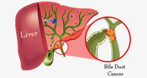 Bile Duct Cancer Treatment Specialist in Pune, PCMC Maharashtra  service image
