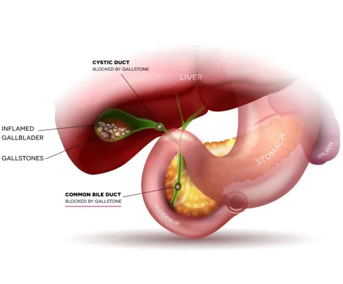 Bile Duct Stones Treatment Specialist in Pune, PCMC, Maharashtra service image