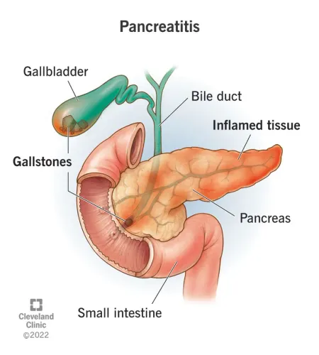 Pancreatitis Treatment Specialist in Pune, PCMC, Maharashtra  service image