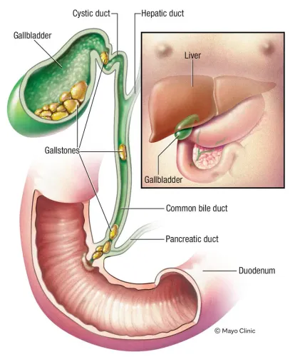 Gallbladder Stone Treatment Specialist in Pune, PCMC, Maharashtra  service image