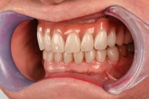 VENEERS AND SMILE RECONSTRUCTION PROCEDURES service image