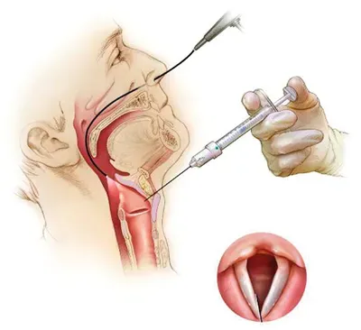 Cosmetic Voice Surgery (Injection Laryngoplasty) service image